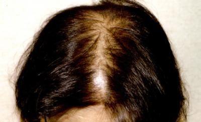 油性头发脱发的治疗 头发出油一定是脱发信号吗