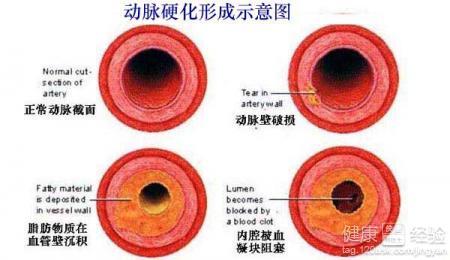 动脉硬化症状有哪些 动脉硬化的6大症状 你知道几个