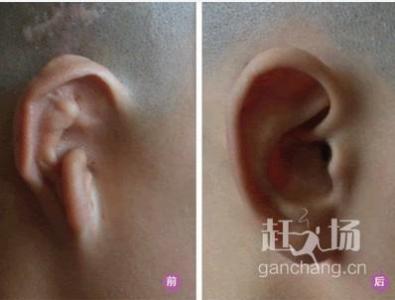 外耳再造 外耳再造 外耳再造-外耳再造概述，外耳再造-肋软骨造耳最佳手术