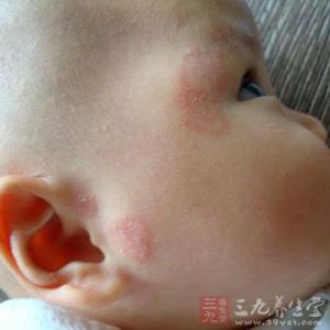 宝宝干性湿疹怎么根治 宝宝湿疹怎么办 教你如何根治宝宝湿疹
