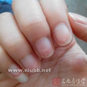 指甲盖上白点 指甲上有白点是怎么回事 手指盖上的疾病