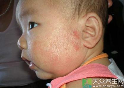 婴儿面部湿疹的护理 面部湿疹护理措施 12个面部湿疹的护理措施