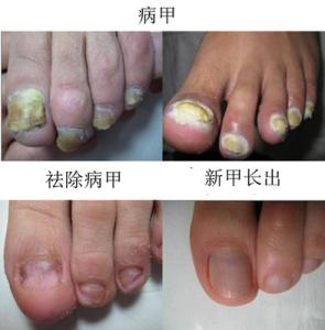 灰指甲最佳治疗方法 治疗灰指甲的最佳方法 如何治疗灰指甲
