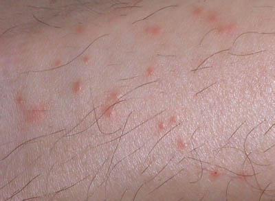 慢性湿疹如何根治 湿疹是怎么引起的？湿疹的原因？