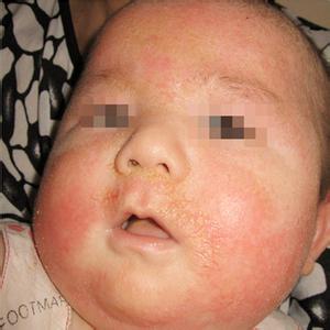 婴儿湿疹多久能自愈 婴儿湿疹症状
