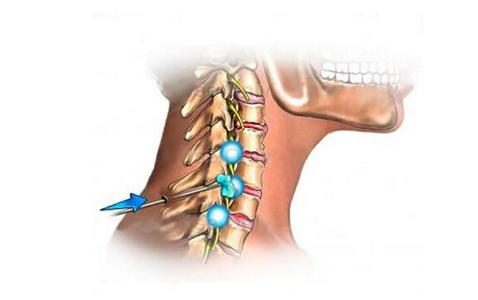 颈椎骨质增生治疗偏方 颈椎骨质增生偏方