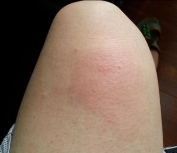 被蚊子咬了怎么止痒 蚊子咬了肿很大，怎么止痒？