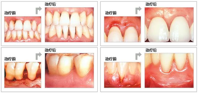 牙周炎治疗费用多少 牙周炎能治好吗