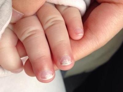 孩子手指甲上有白点 孩子指甲上有白点是什么原因