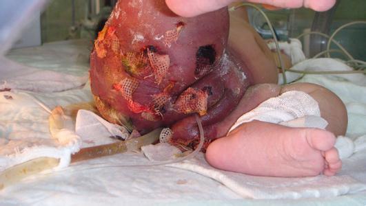 新生儿皮下坏疽 新生儿皮下坏疽 新生儿皮下坏疽-概述，新生儿皮下坏疽-治疗措施
