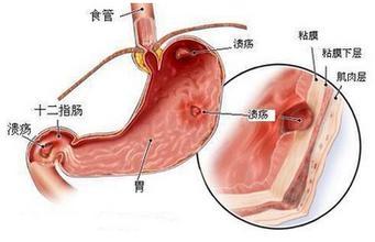 十二指肠溃疡的症状 十二指肠溃疡吃什么药