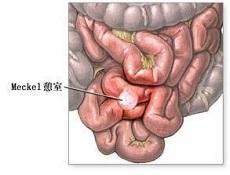 异位胰腺 异位胰腺 异位胰腺-病因，异位胰腺-病理