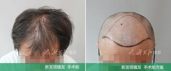 植发手术有用吗 植发有用吗 植发手术有效果吗