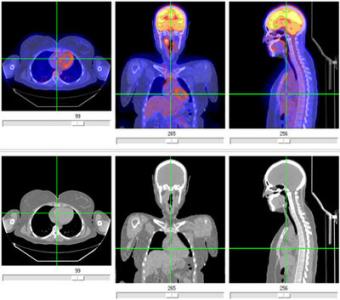petct检查 Petct检查身体准不准
