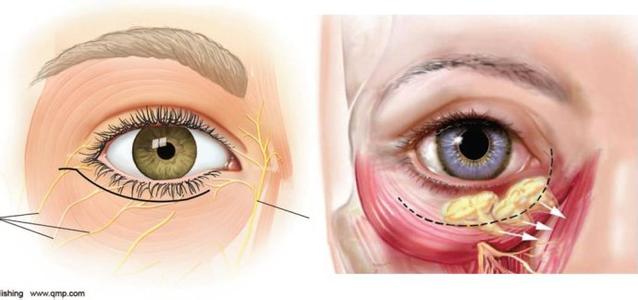 眼袋整形术 眼袋整形术 眼袋整形术-手术概述，眼袋整形术-眼袋类型