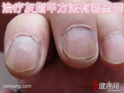 灰指甲中药治疗方法 治疗灰指甲用什么药好【灰指甲的治疗方法】