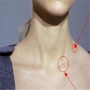 颈部淋巴癌早期症状 颈部淋巴 颈部淋巴-临床表现，颈部淋巴-症状外观