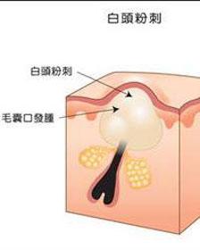 白头粉刺会自动消失吗 怎么去白头粉刺