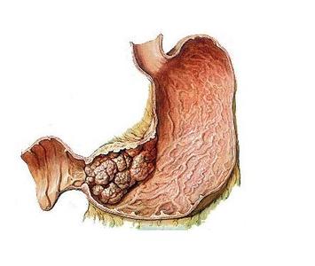 胃间质瘤是恶性肿瘤吗 胃间质瘤 胃间质瘤-胃肠道间质肿瘤的基础研究