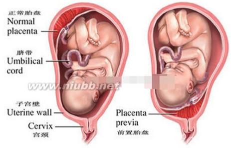 胎盘后壁会是男孩吗 胎盘后壁生男生女