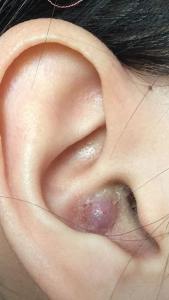 耳朵里面长痘痘 耳朵里面长痘痘是什么原因？