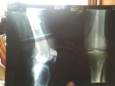 脚踝骨折手术后的恢复 脚踝骨折后怎样恢复得快？