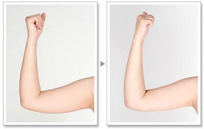 手臂吸脂手术 手臂吸脂术 手臂吸脂术-简介，手臂吸脂术-手术方法