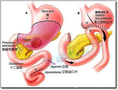 胆汁反流性胃炎 胆汁反流性胃炎如何防治