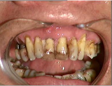 牙龈炎病因 边缘性龈炎 边缘性龈炎-病因，边缘性龈炎-症状
