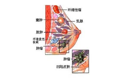 乳房纤维腺瘤 乳房纤维腺瘤-基本资料，乳房纤维腺瘤-疾病概述