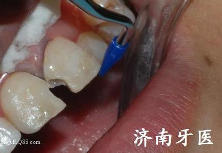 牙釉质发育不全 牙釉质发育不全-病因，牙釉质发育不全-临床表现