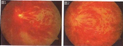 视网膜静脉阻塞 视网膜静脉阻塞-流行病学，视网膜静脉阻塞-病因