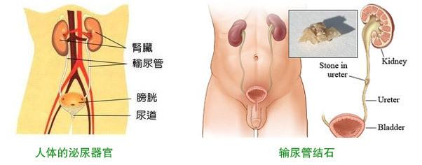 尿道结石症状 男女尿道结石症状大有不同