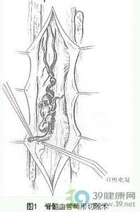 脊髓血管畸形 脊髓血管畸形 脊髓血管畸形-概述，脊髓血管畸形-病理