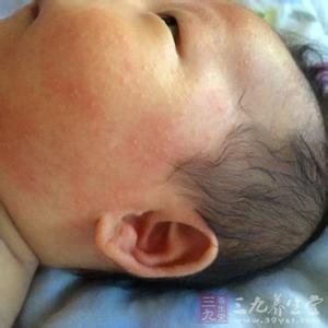 新生儿湿疹 新生儿湿疹-概述，新生儿湿疹-临床表现