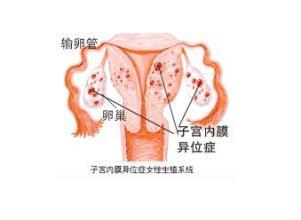 子宫内膜移位治疗 子宫移位 子宫移位-常见类型，子宫移位-治疗