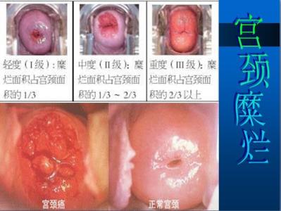 宫颈糜烂1度 宫颈糜烂1度-病因，宫颈糜烂1度-分类