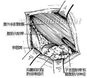 股疝修复术 股疝修复术-介绍，股疝修复术-手术方法的选择