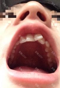 畸形牙齿矫正 牙齿畸形 牙齿畸形-类型，牙齿畸形-虎牙矫正方法