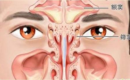 儿童鼻窦炎 儿童鼻窦炎-疾病概述，儿童鼻窦炎-临床表现