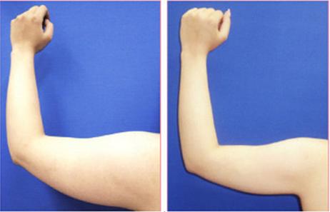 手臂抽脂术 手臂抽脂术-概况，手臂抽脂术-方法