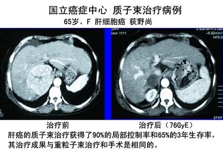 中国质子治疗肝癌 质子治疗肝癌