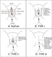 女性生殖器切割 女性生殖器切割-程序，女性生殖器切割-没有健康