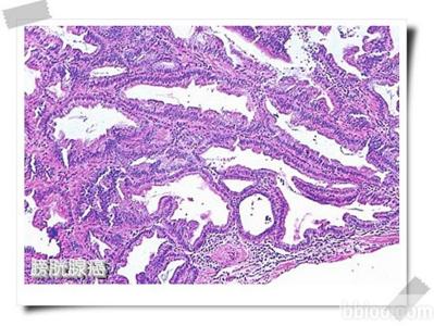 腺癌 腺癌-腺癌简介，腺癌-病理生理