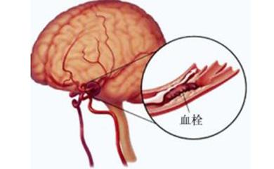 治疗脑血栓的特效药 脑血栓的治疗方法