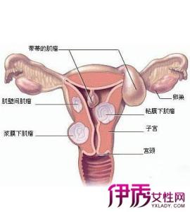 子宫粘膜下肌瘤病因 子宫腺肌瘤 子宫腺肌瘤-概述，子宫腺肌瘤-病因