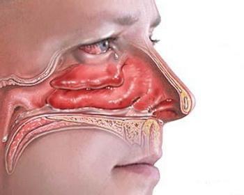 萎缩性鼻炎的表现症状 萎缩性鼻炎 萎缩性鼻炎-临床表现，萎缩性鼻炎-病因