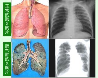 治疗肺气肿的进口药 肺气肿怎么治疗好