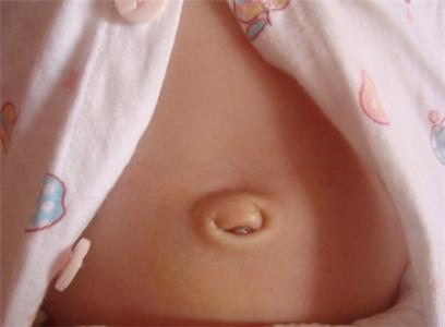 婴儿脐疝 婴儿脐疝-病因，婴儿脐疝-临床表现