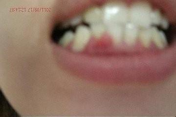 后槽牙牙龈肿痛 教你十分钟缓解后槽牙牙龈肿